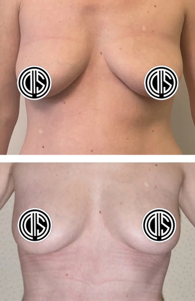Before and after fat transfer breast augmentation, case 5.