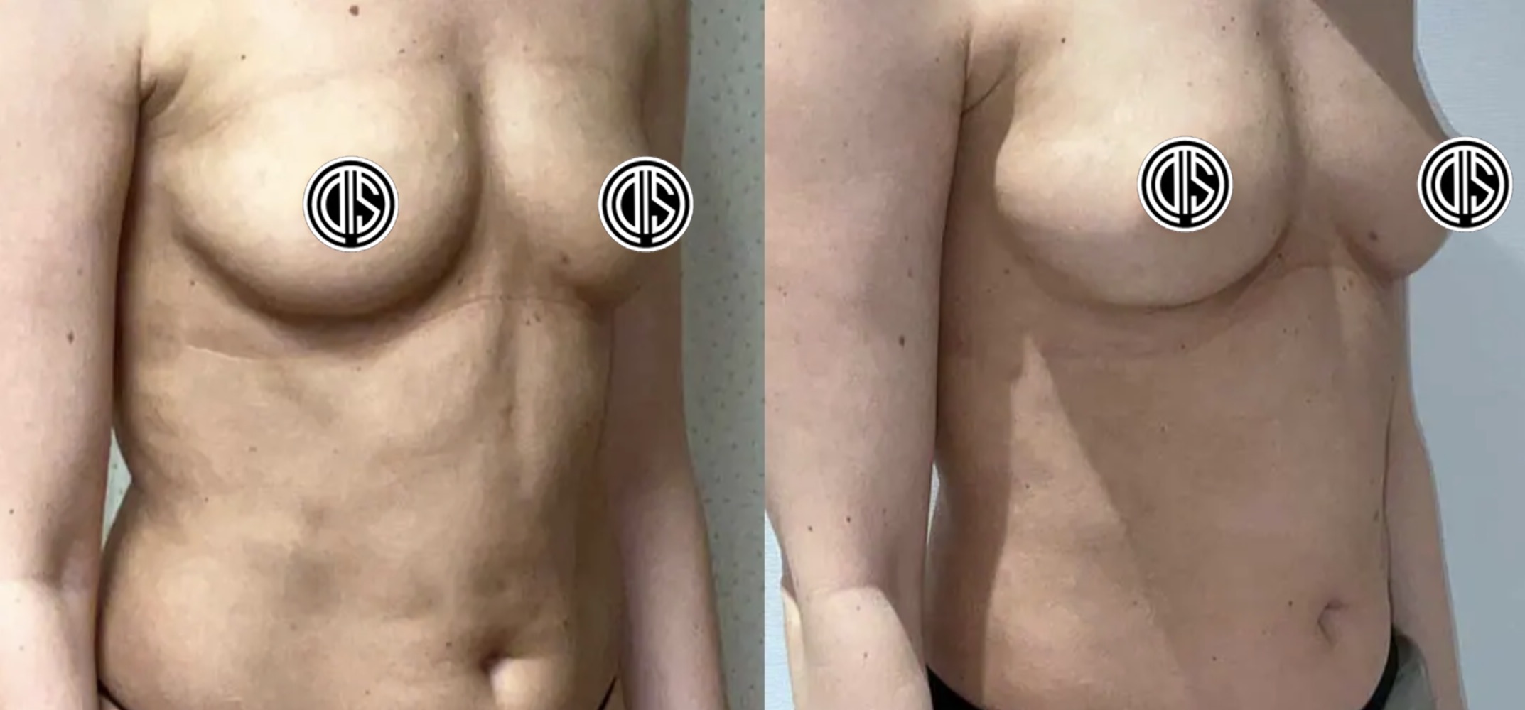 Before and after fat transfer breast augmentation, case 6.