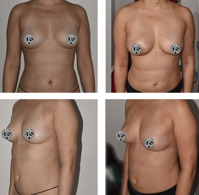 Before and after fat transfer breast augmentation, case 7.