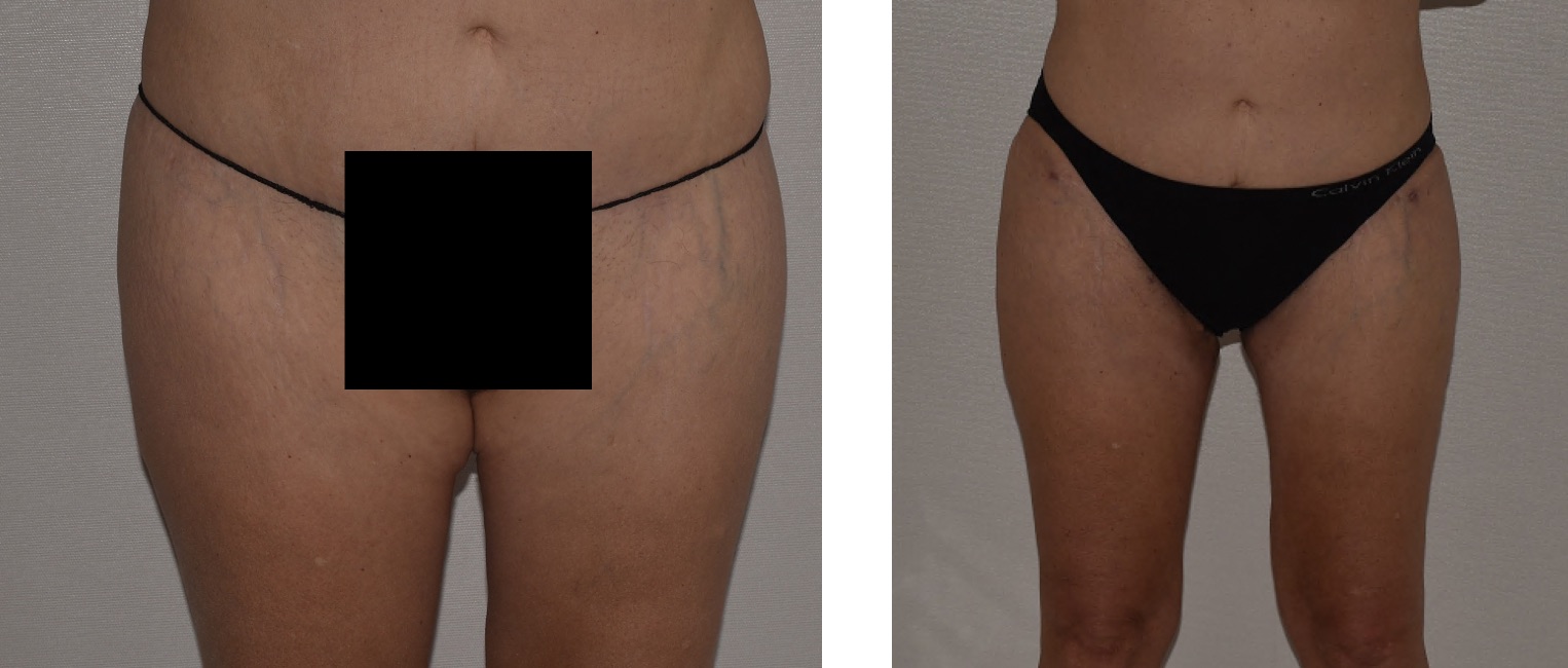 Before and after thigh lift, case 4.