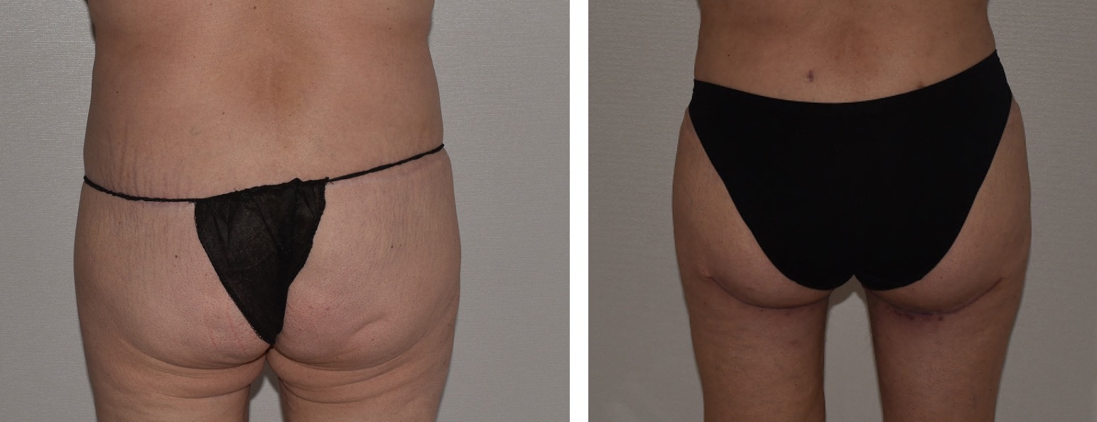 Before and after thigh lift, case 5.