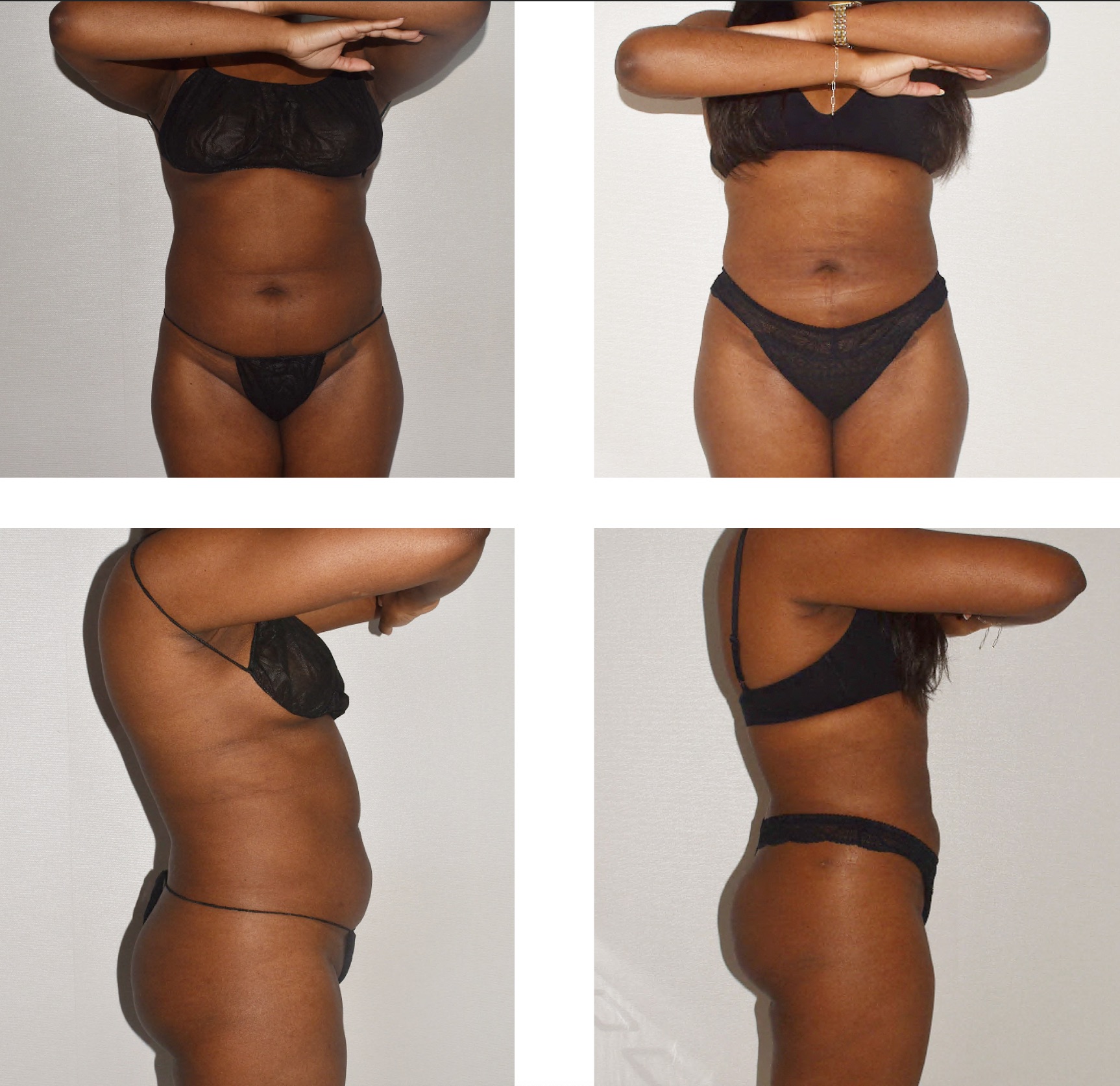 A woman in her late thirties underwent liposuction of the abdomen and flanks with BodyTite.