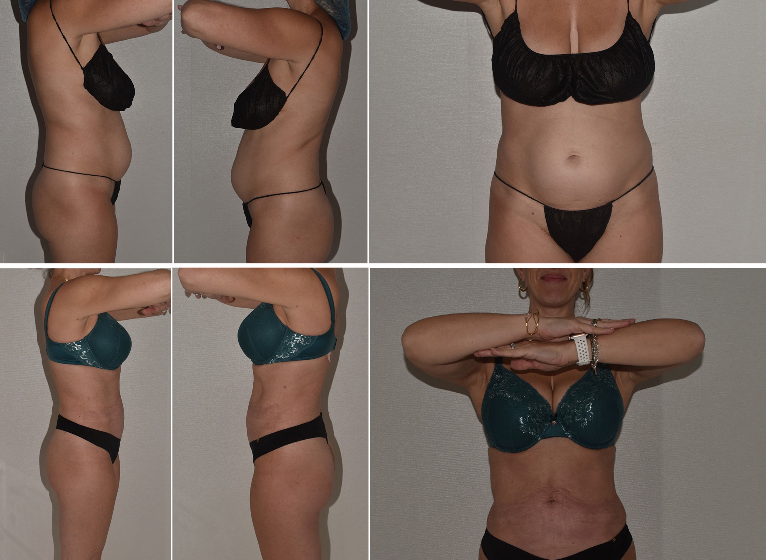 Before and after treatment of paradoxical adipose hyperplasia, case 1.