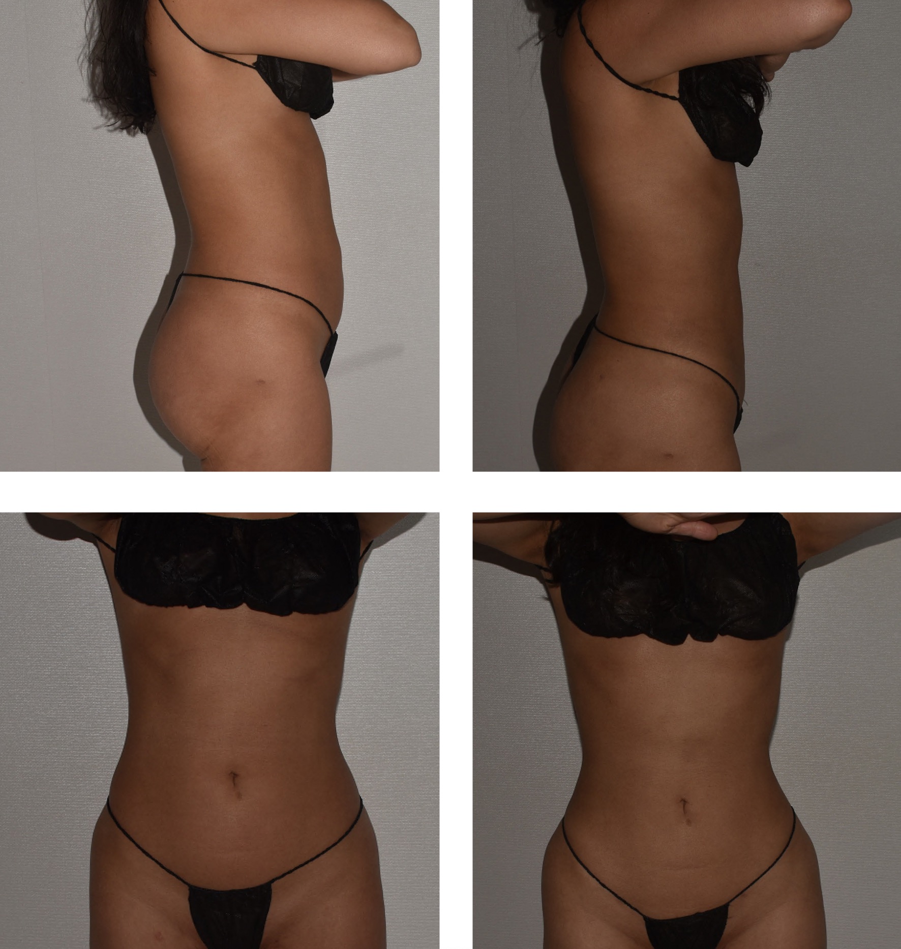 Before and after Lipo 360, case 10.