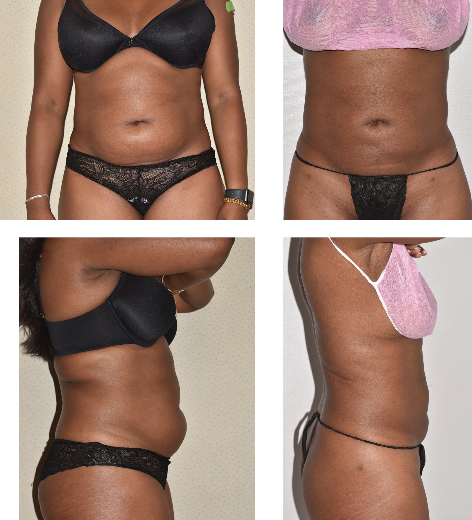 Before and after treatment of paradoxical adipose hyperplasia, case 3.