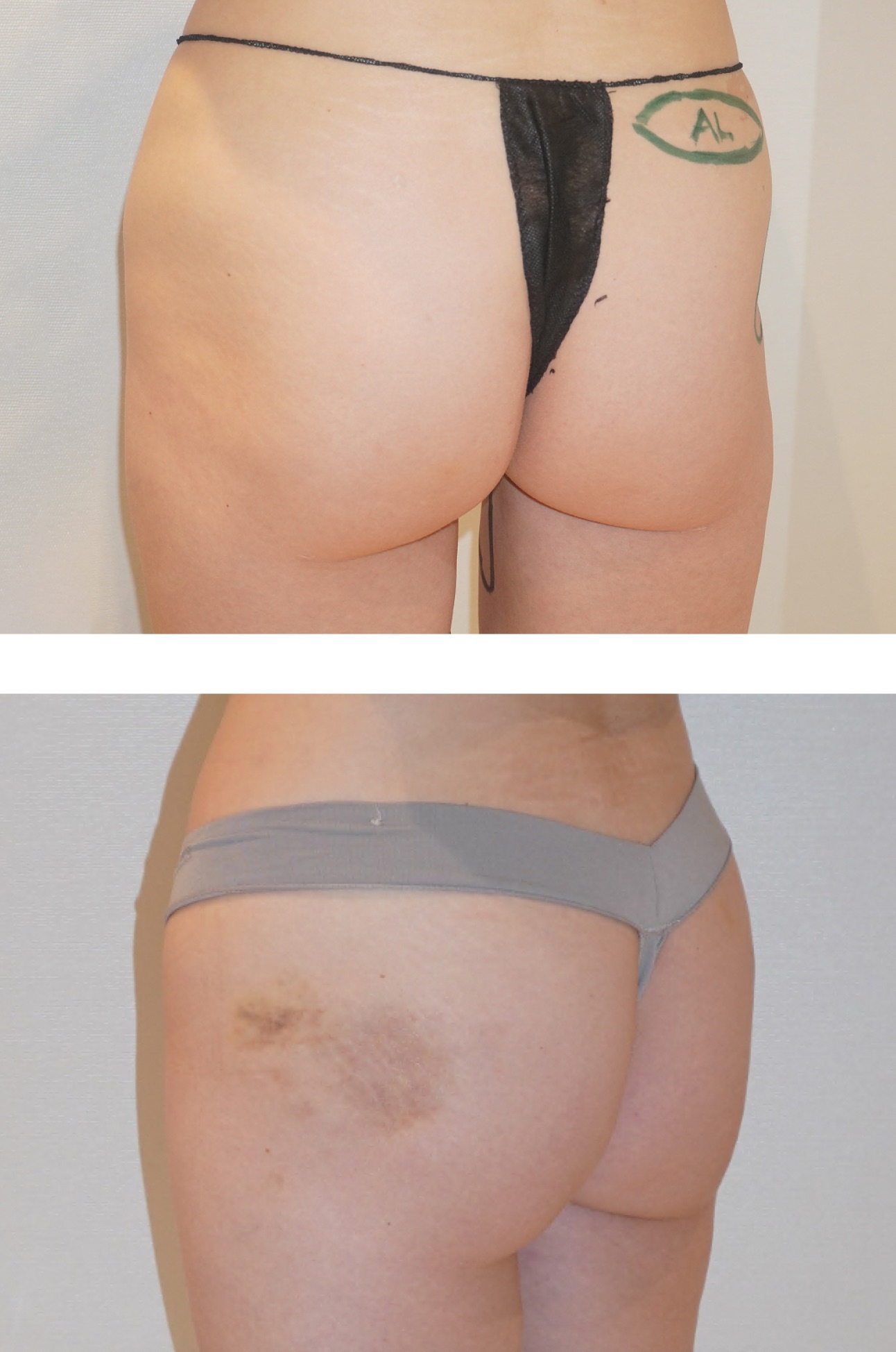 Before and after Alloclae treatment, case 3.
