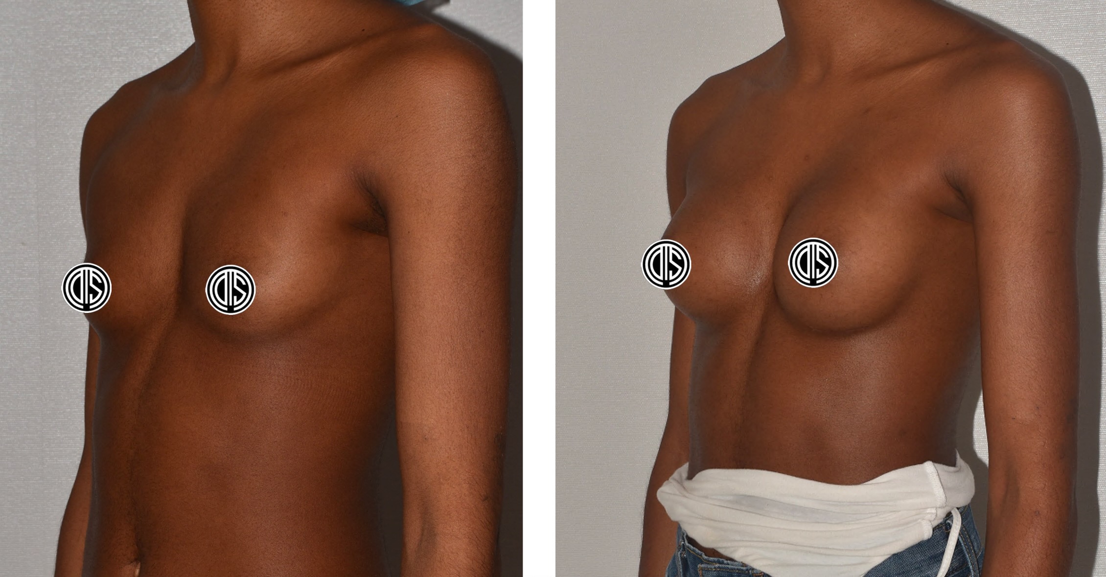 Before and after breast augmentation, case 5.