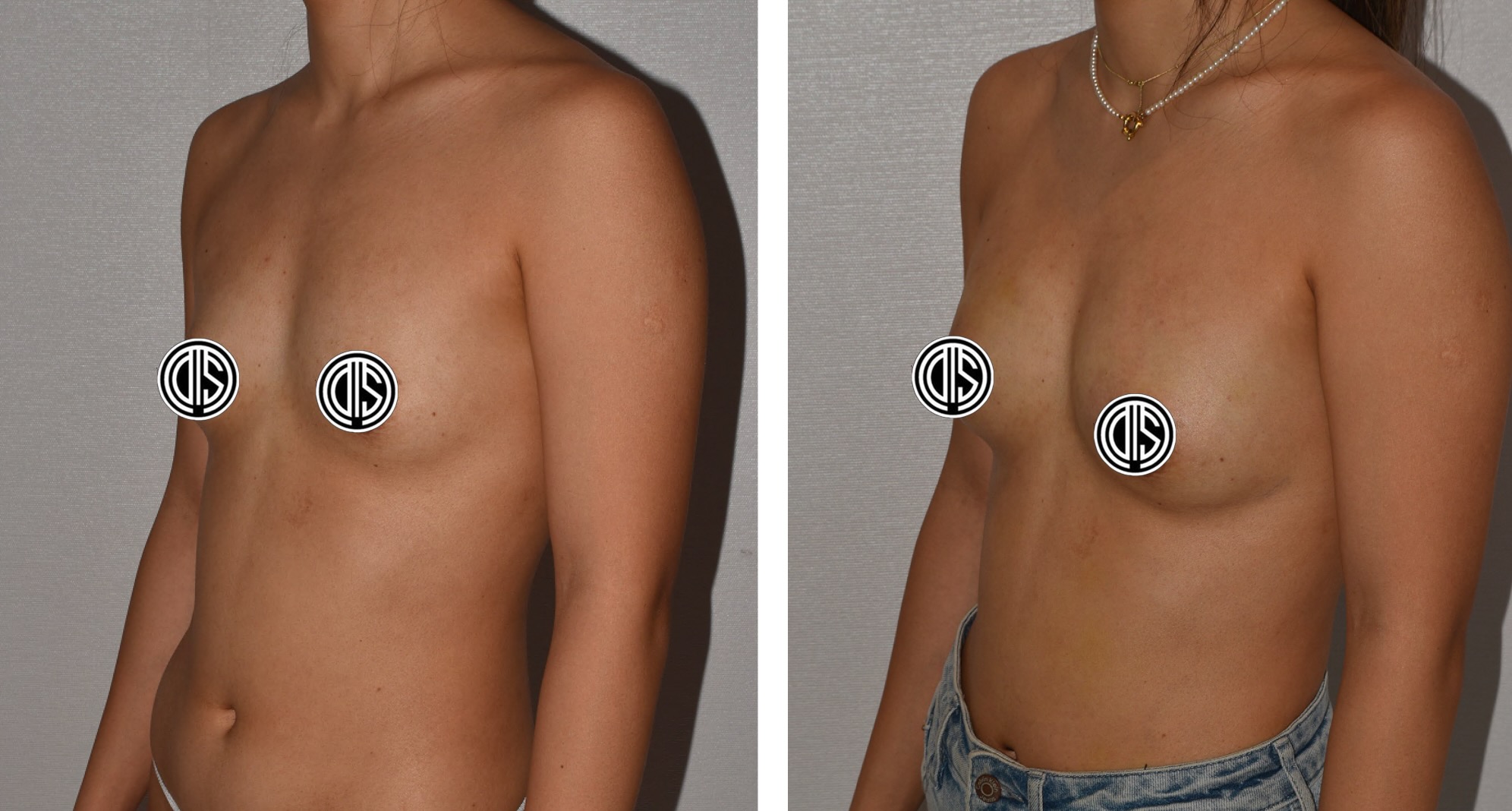 Before and after breast augmentation, case 6.
