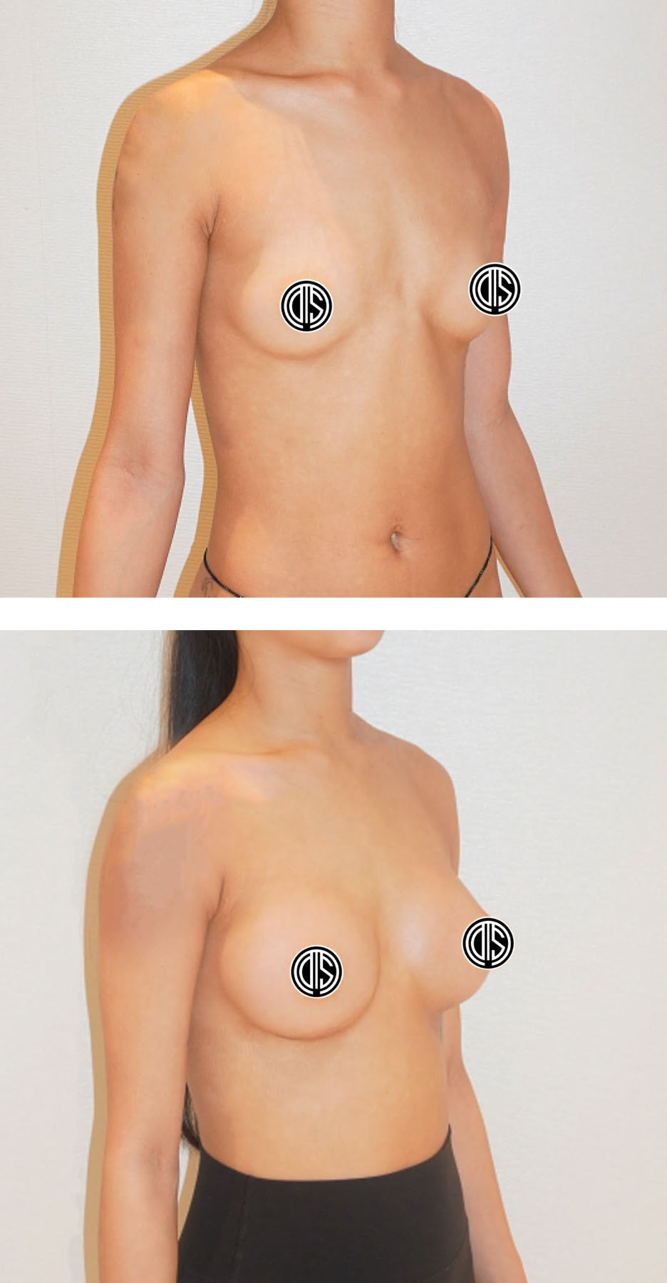 Before and after breast augmentation, case 7.