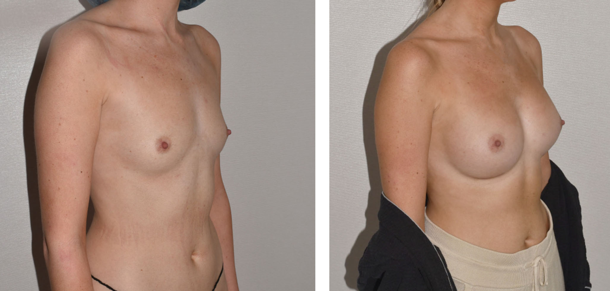 Before and after breast augmentation, case 9.