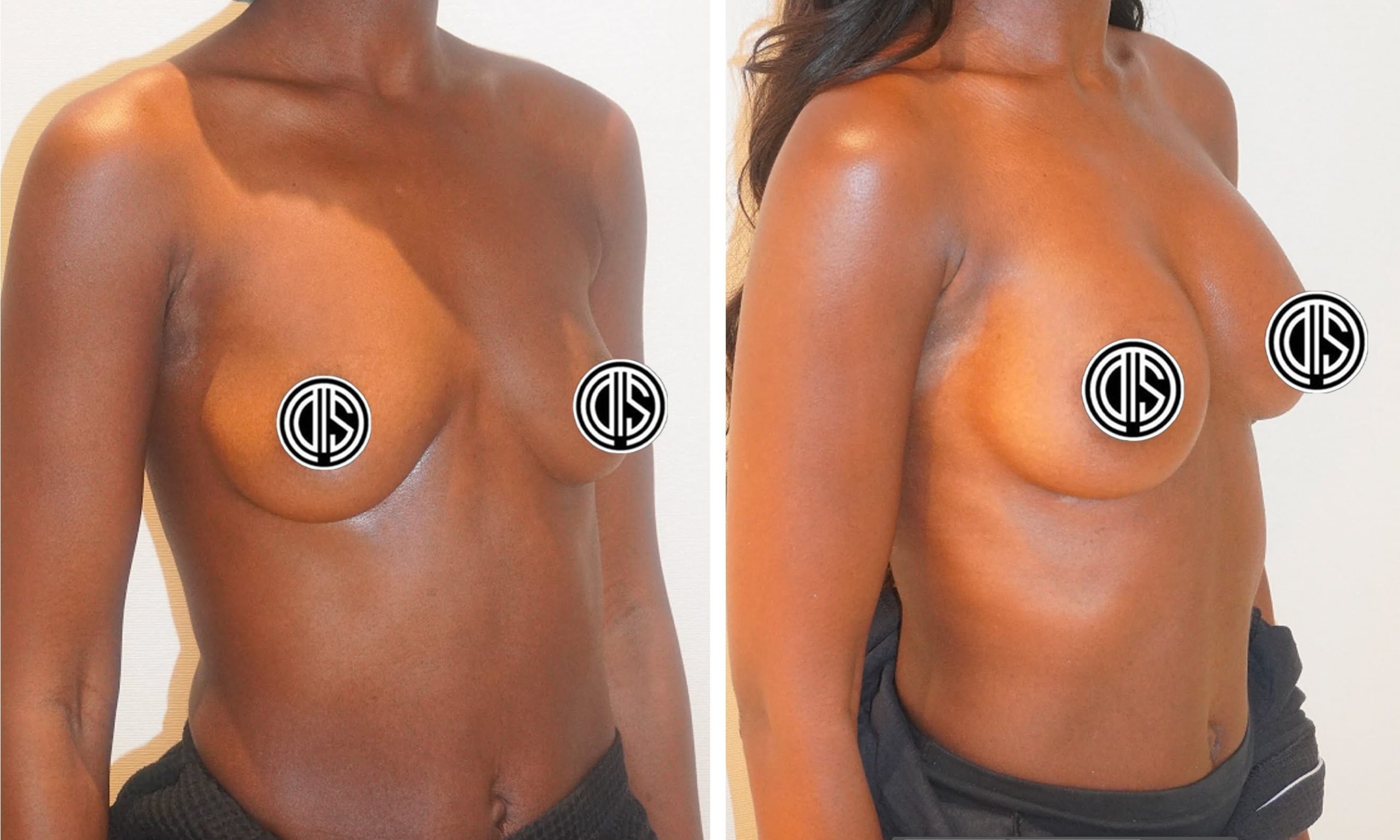 Before and after breast augmentation, case 10.