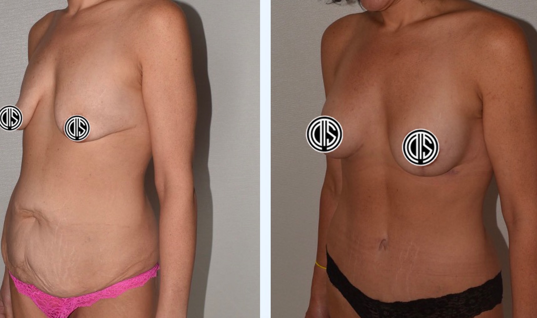 Before and after breast lift, case 12.