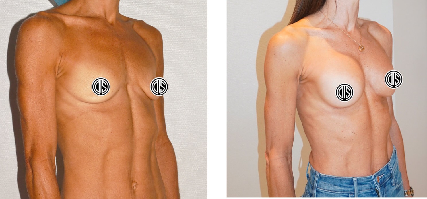 Before and after breast augmentation, case 12.