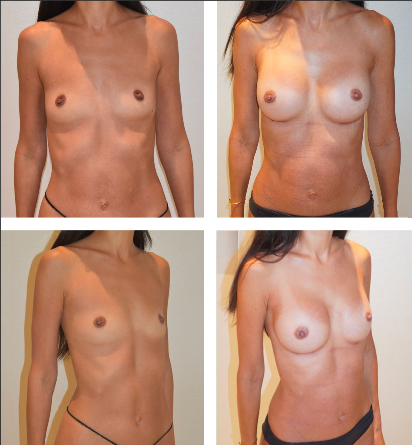 Before and after breast augmentation, case 15.