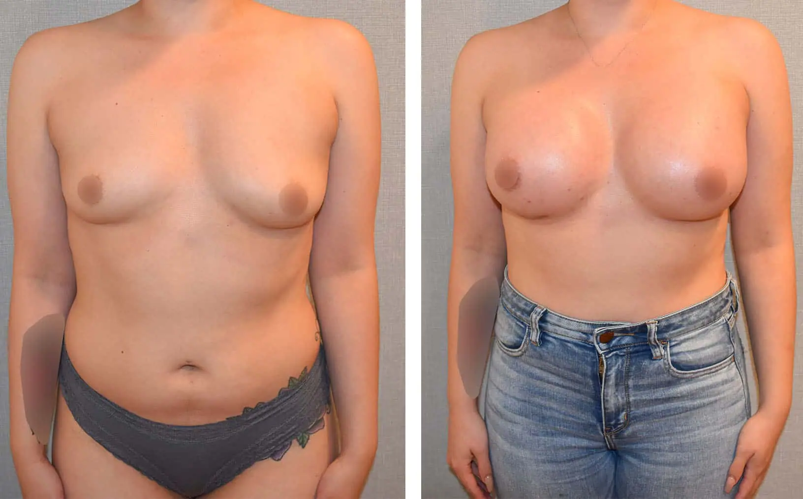 Before and after breast augmentation, case 16.