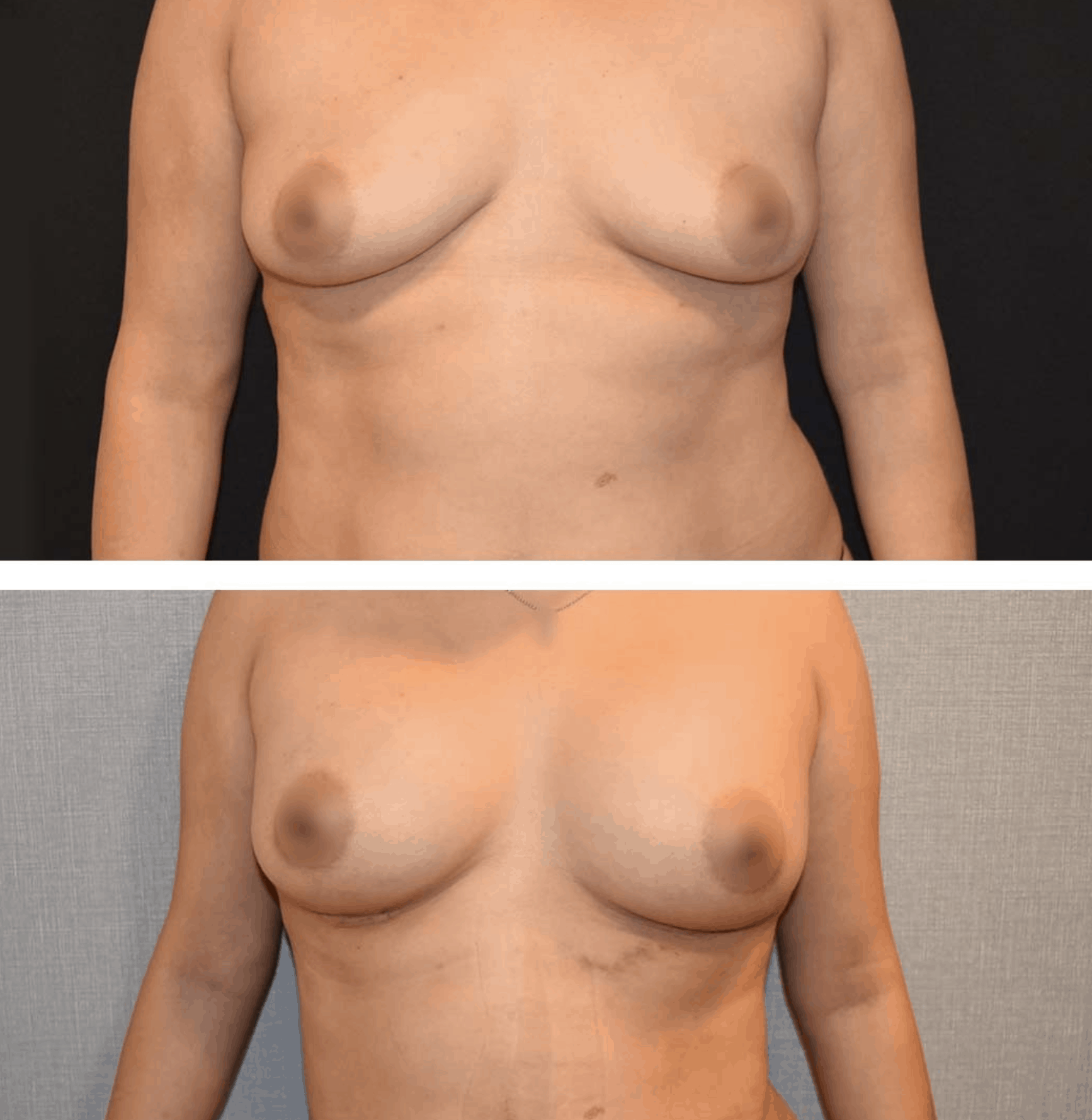 Before and after breast augmentation, case 19.