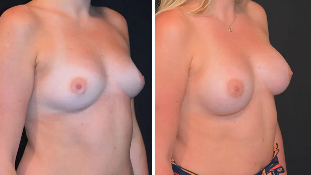 Before and after breast augmentation, case 20.