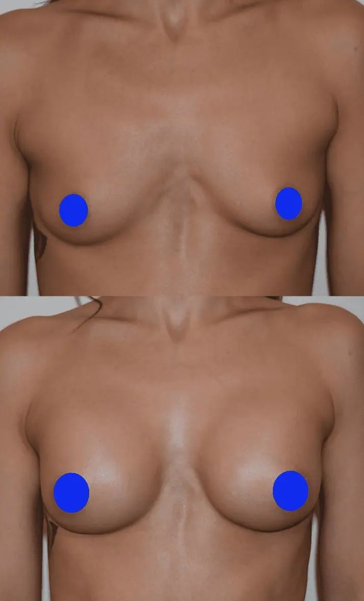 Before and after breast augmentation, case 21.