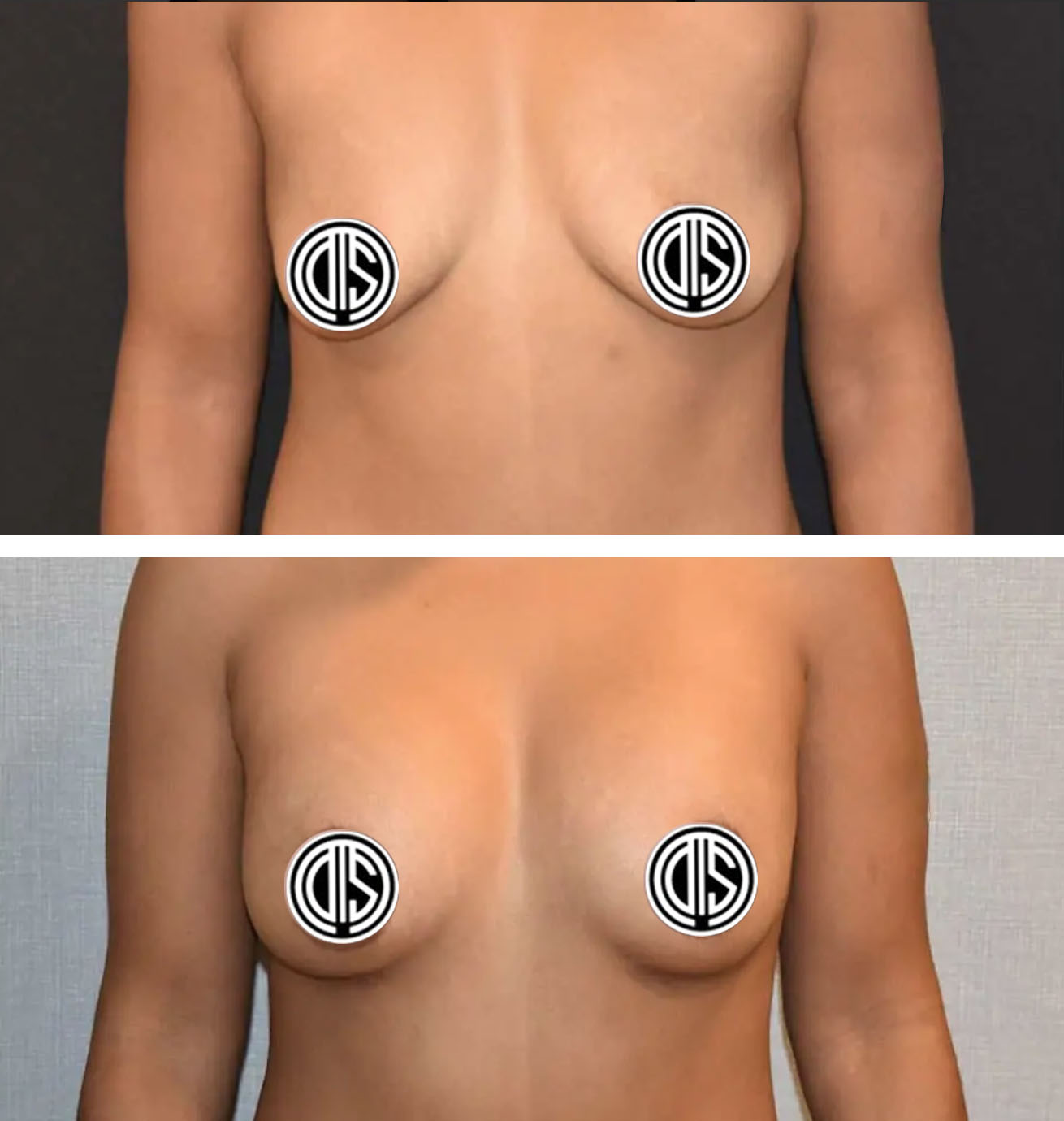 Before and after breast augmentation, case 22.