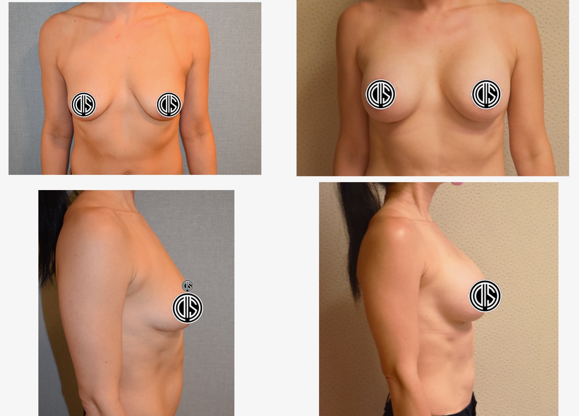 Before and after breast lift, case 14.