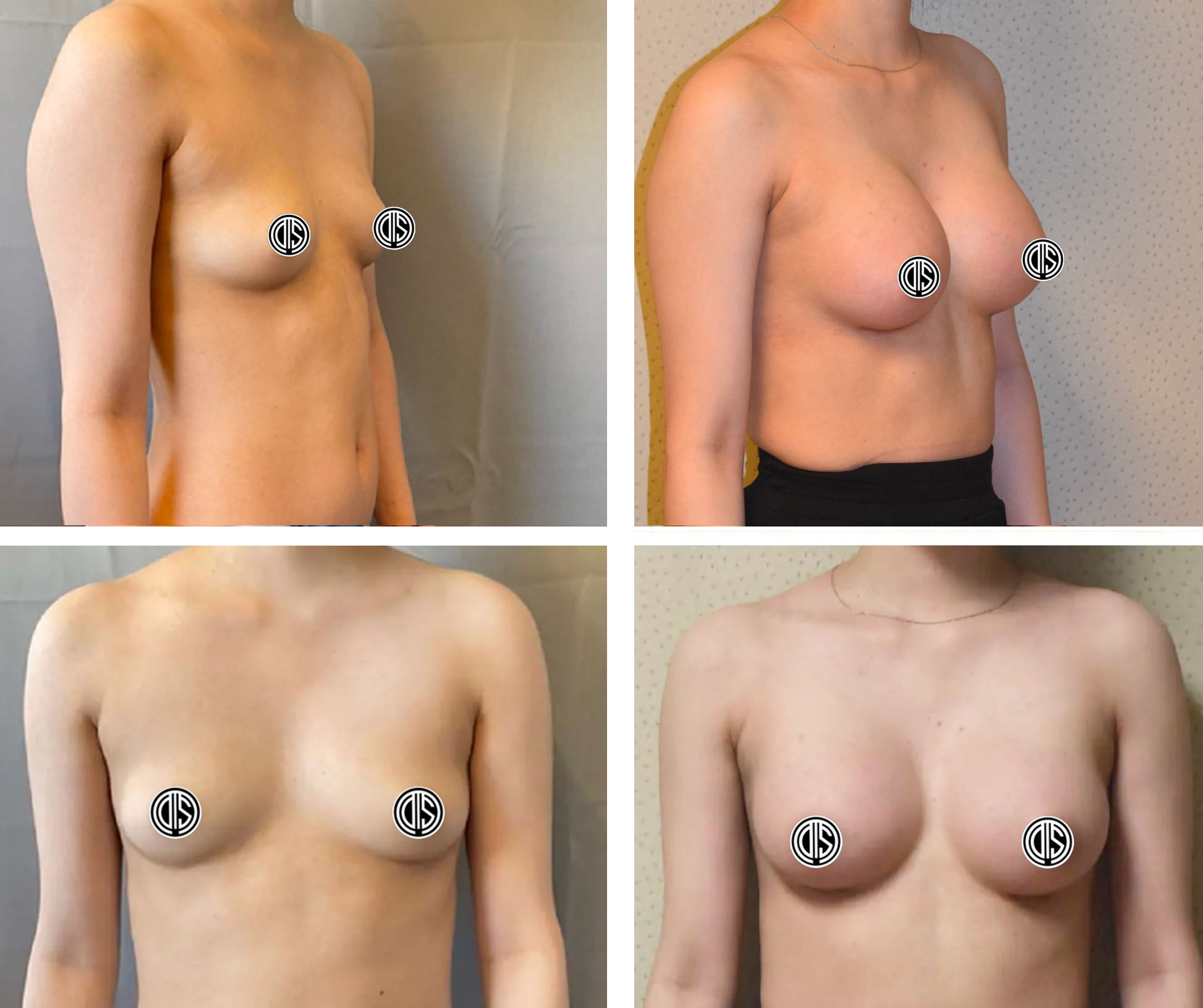 Before and after breast augmentation, case 25.