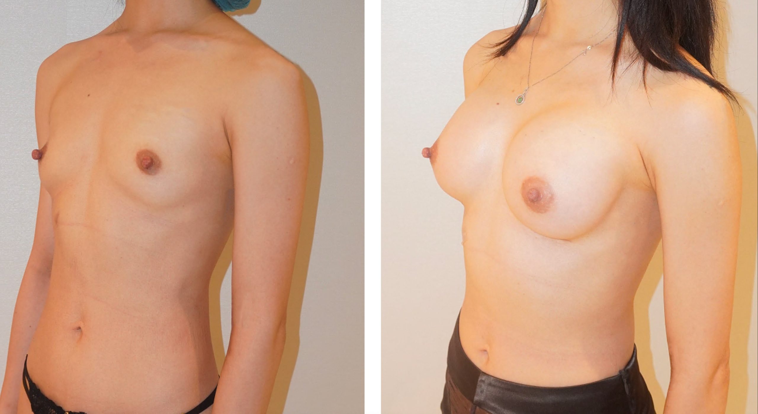 Before and after breast augmentation, case 28.