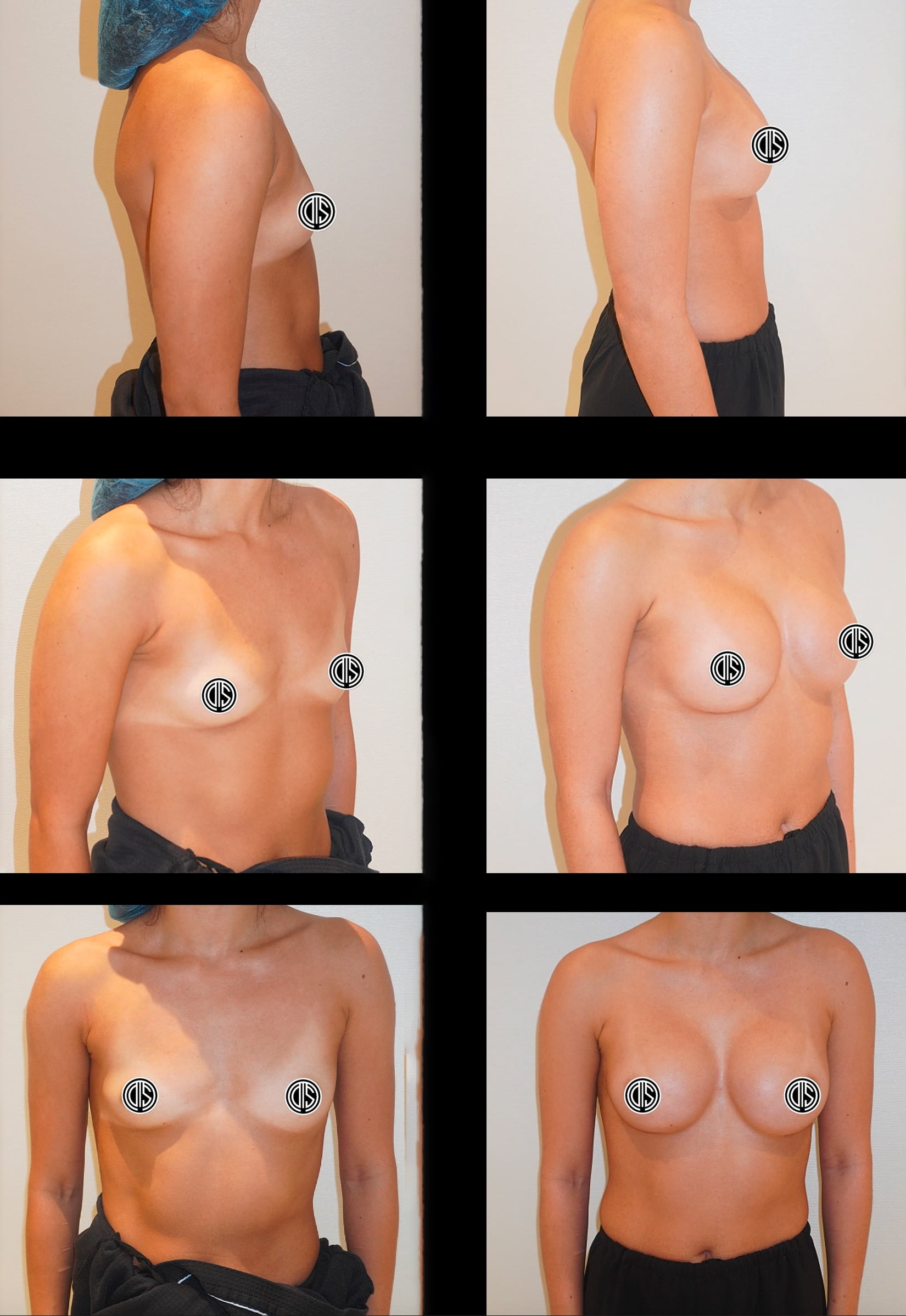 Before and after breast augmentation, case 29.
