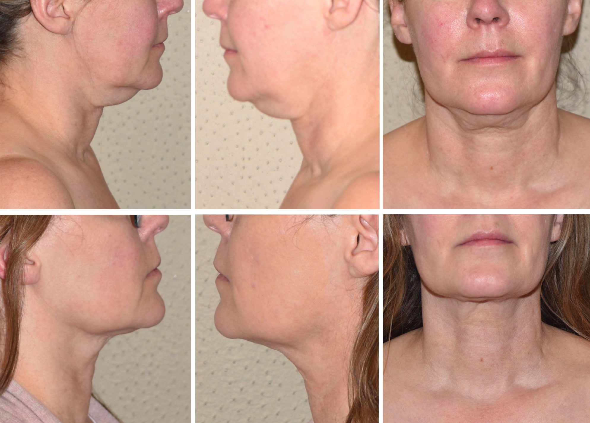 Before and after FaceTite and chin liposuction, case 10.