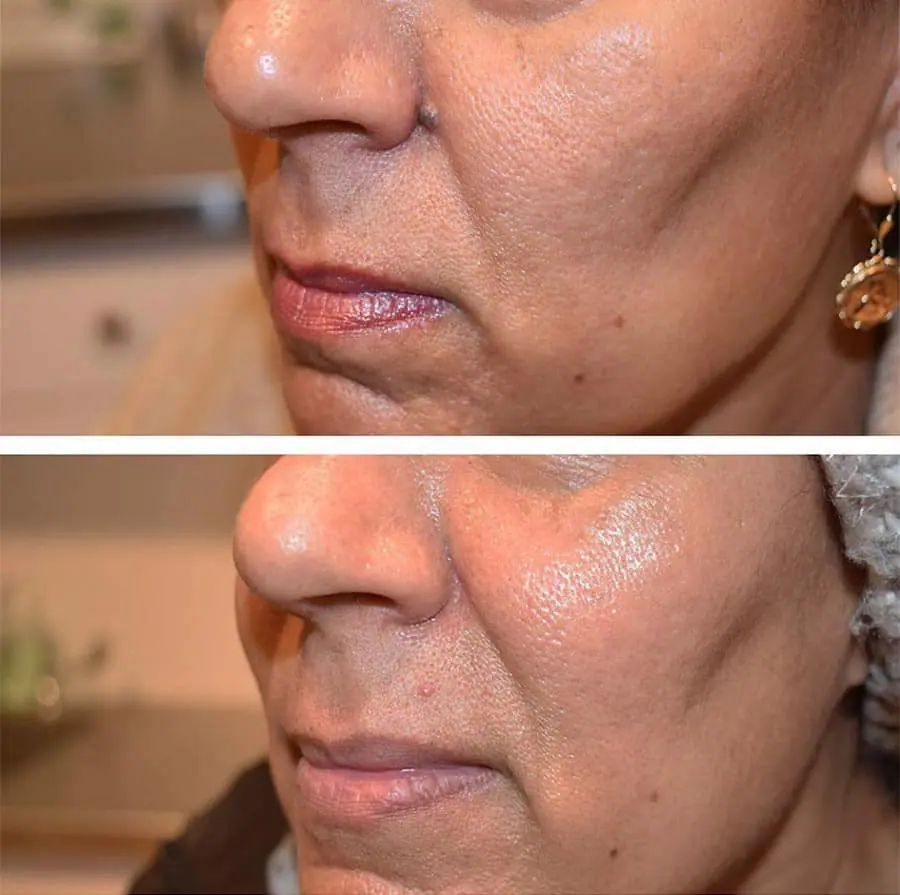 Before and after facial reconstruction, case 1.
