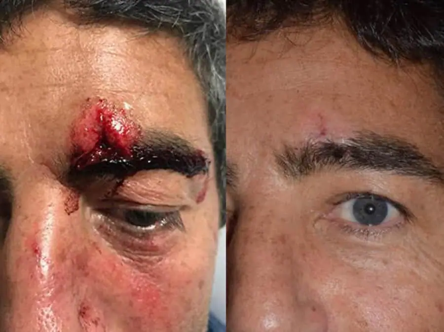 Before and after facial reconstruction, case 2.
