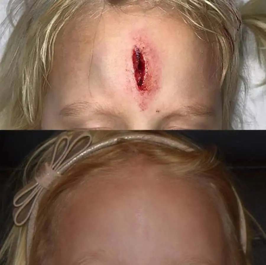Before and after facial reconstruction, case 3.