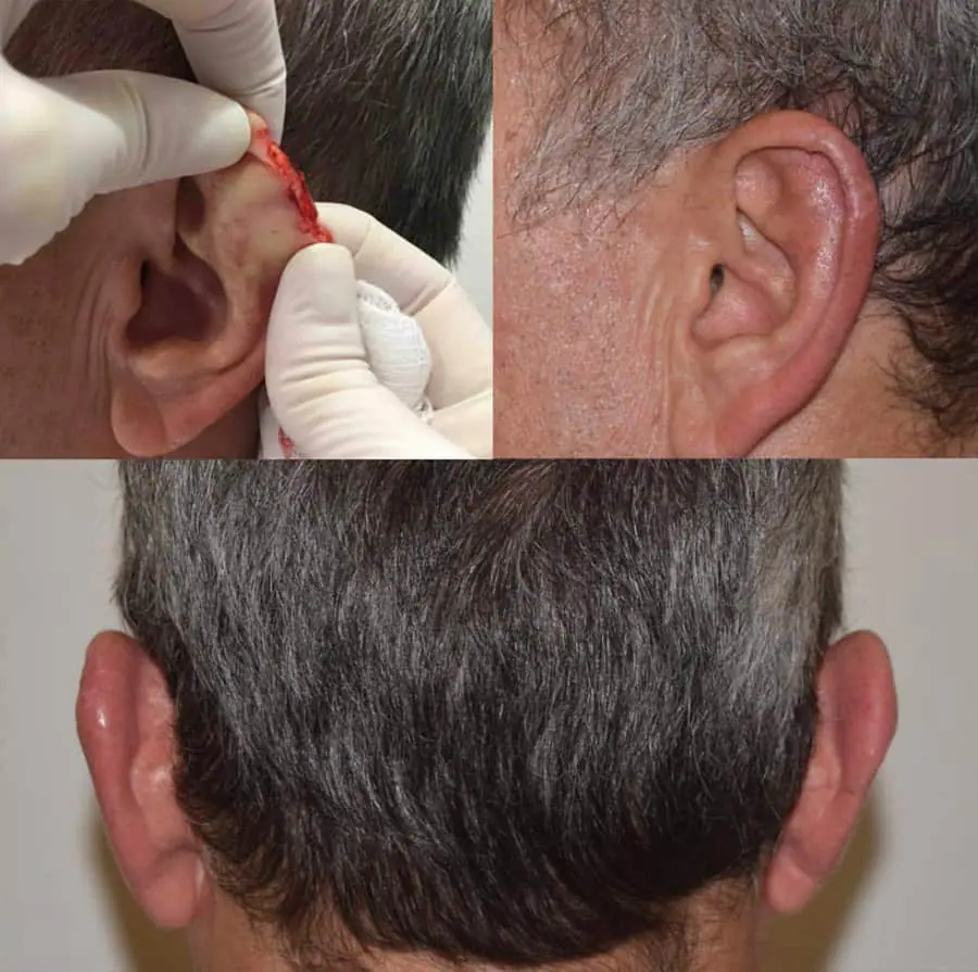 Before and after facial reconstruction, case 4.