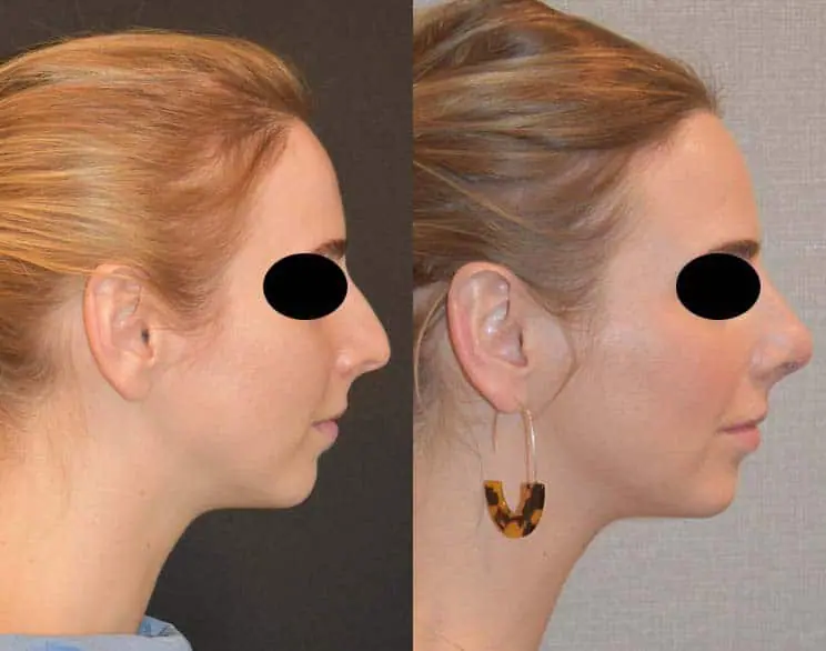 Before and after rhinoplasty, case 1.