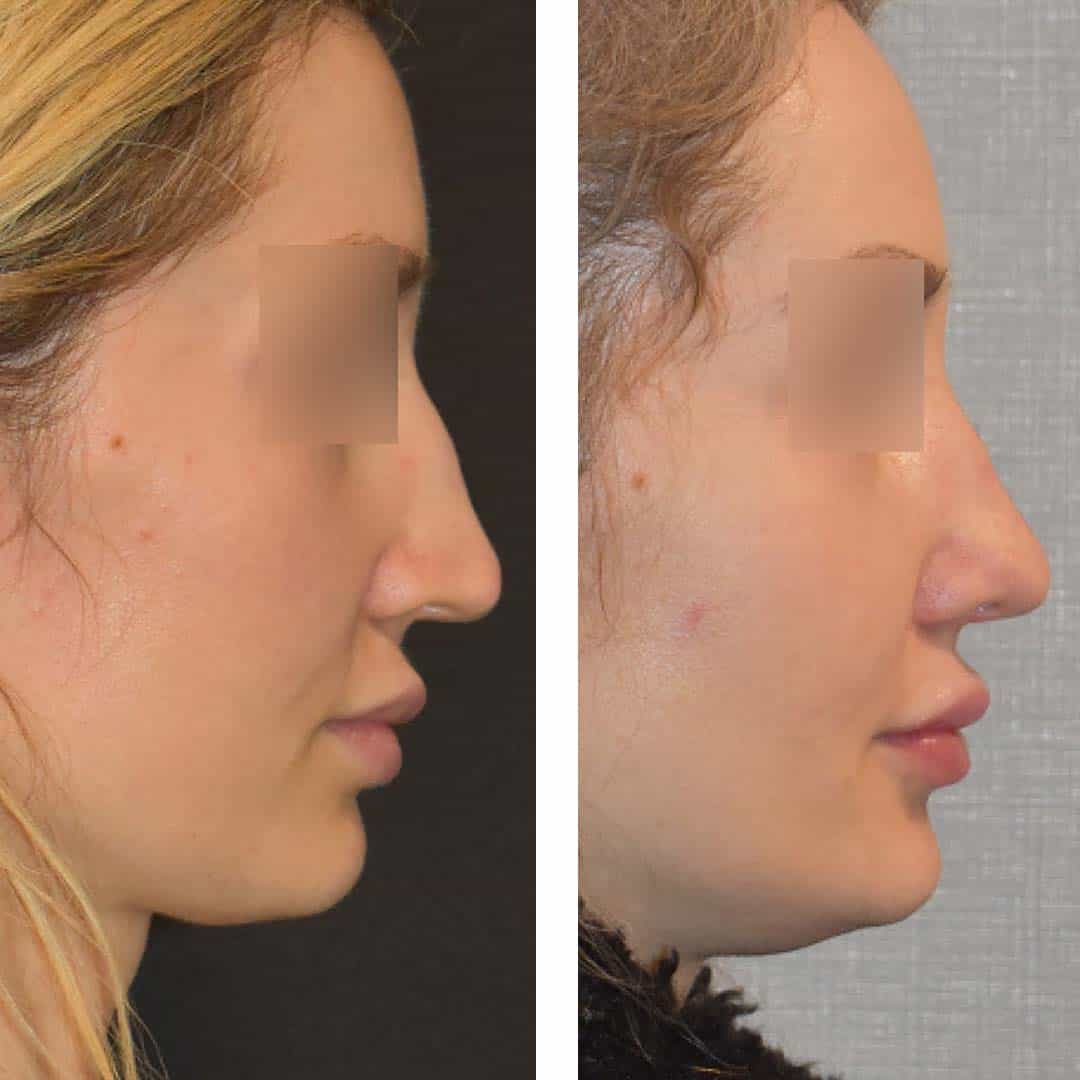 Before and after rhinoplasty, case 2.
