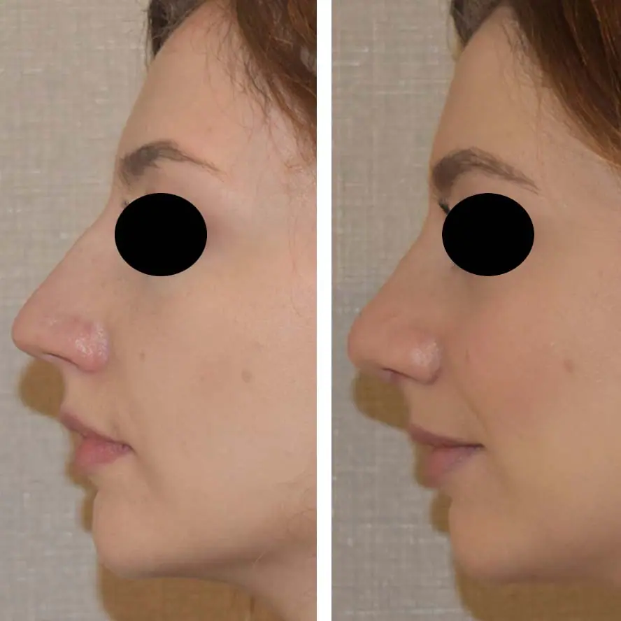 Before and after rhinoplasty, case 3.