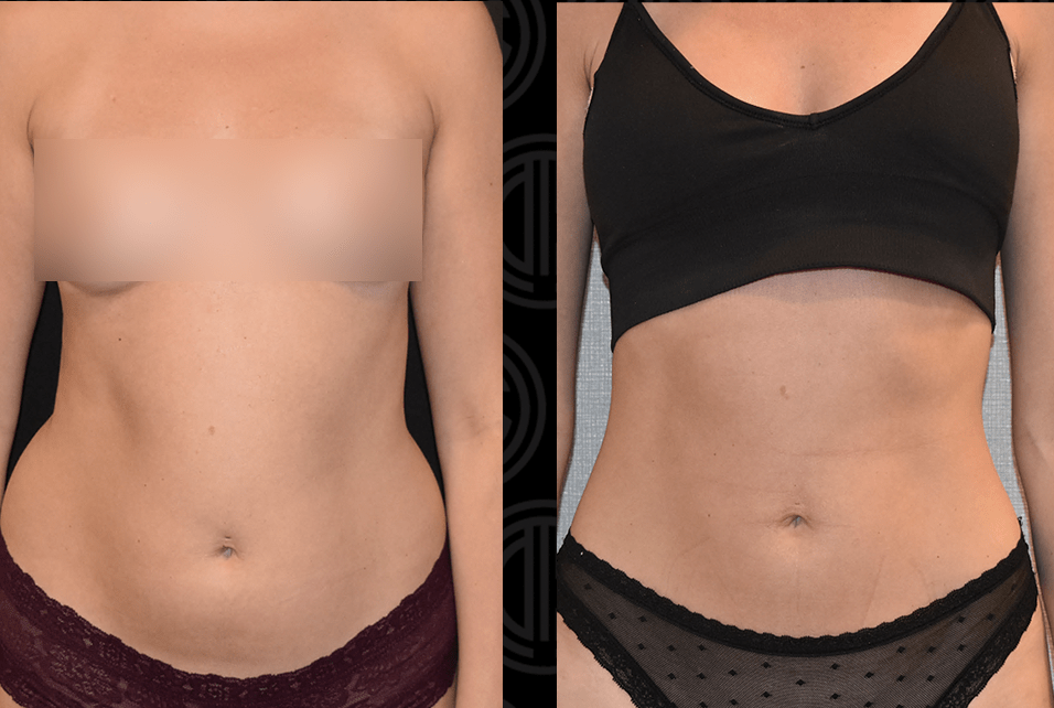 Before and after liposuction, case 1.