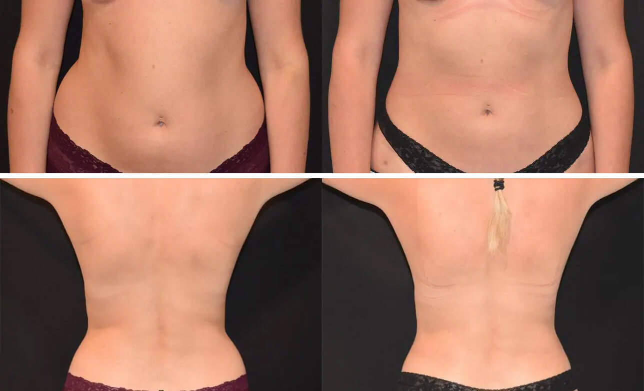Before and after liposuction, case 2.