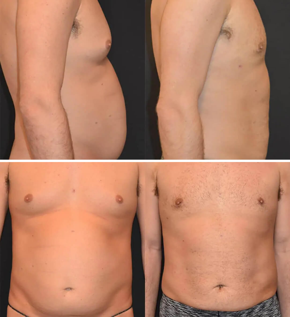 Before and after liposuction, case 3.