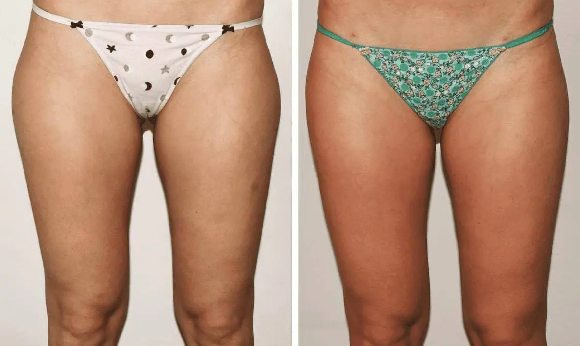 Before and after liposuction, case 8.