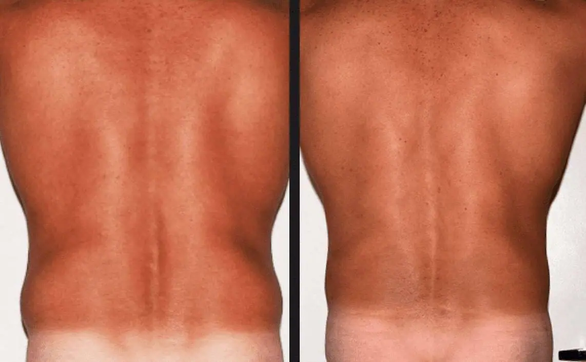 Before and after male liposuction, case 4.