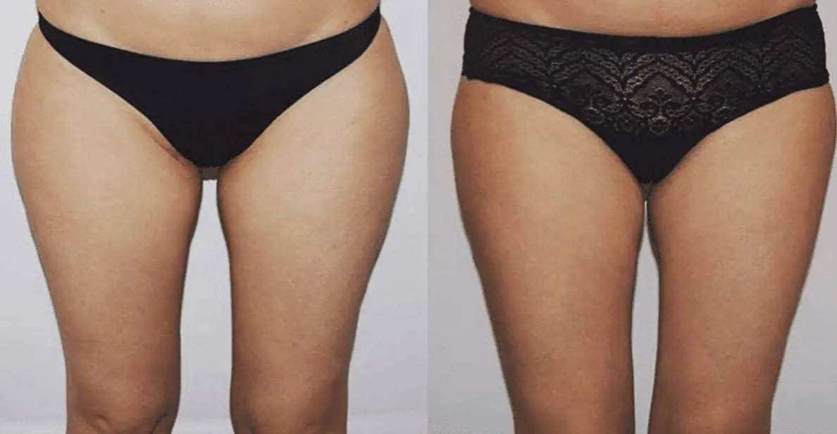 Before and after liposuction, case 11.