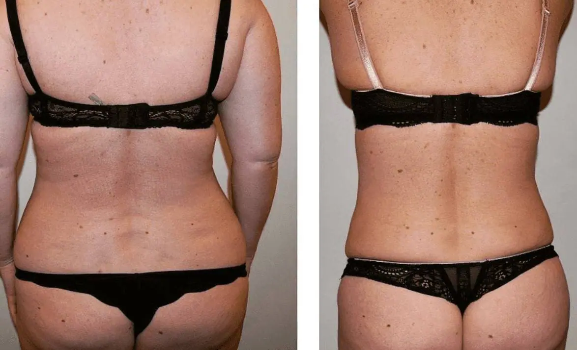 Before and after liposuction, case 12.