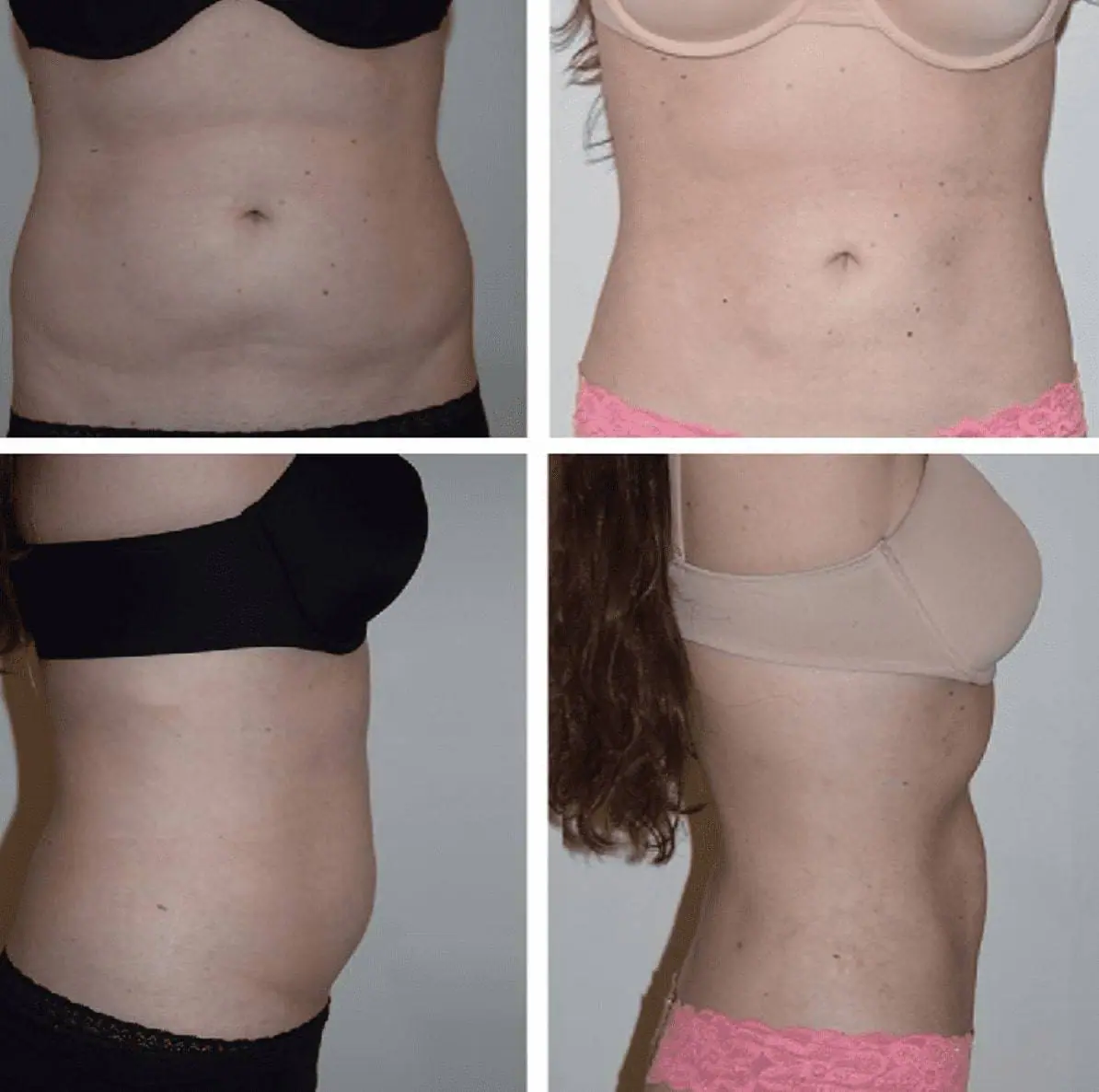 Before and after liposuction, case 16.
