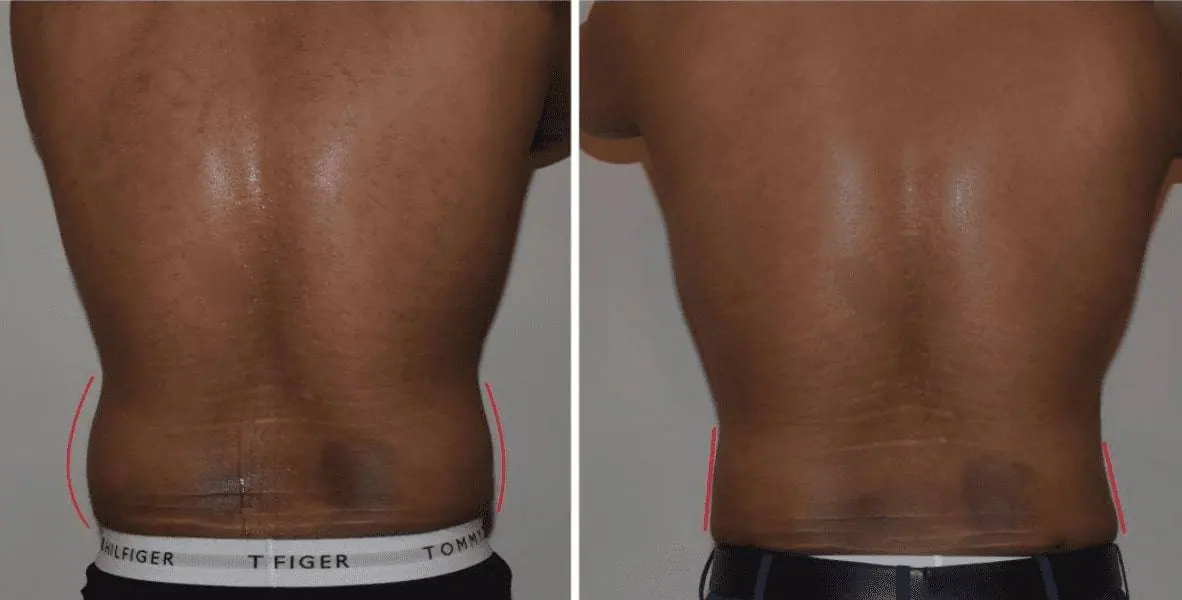 Before and after male liposuction, case 5.