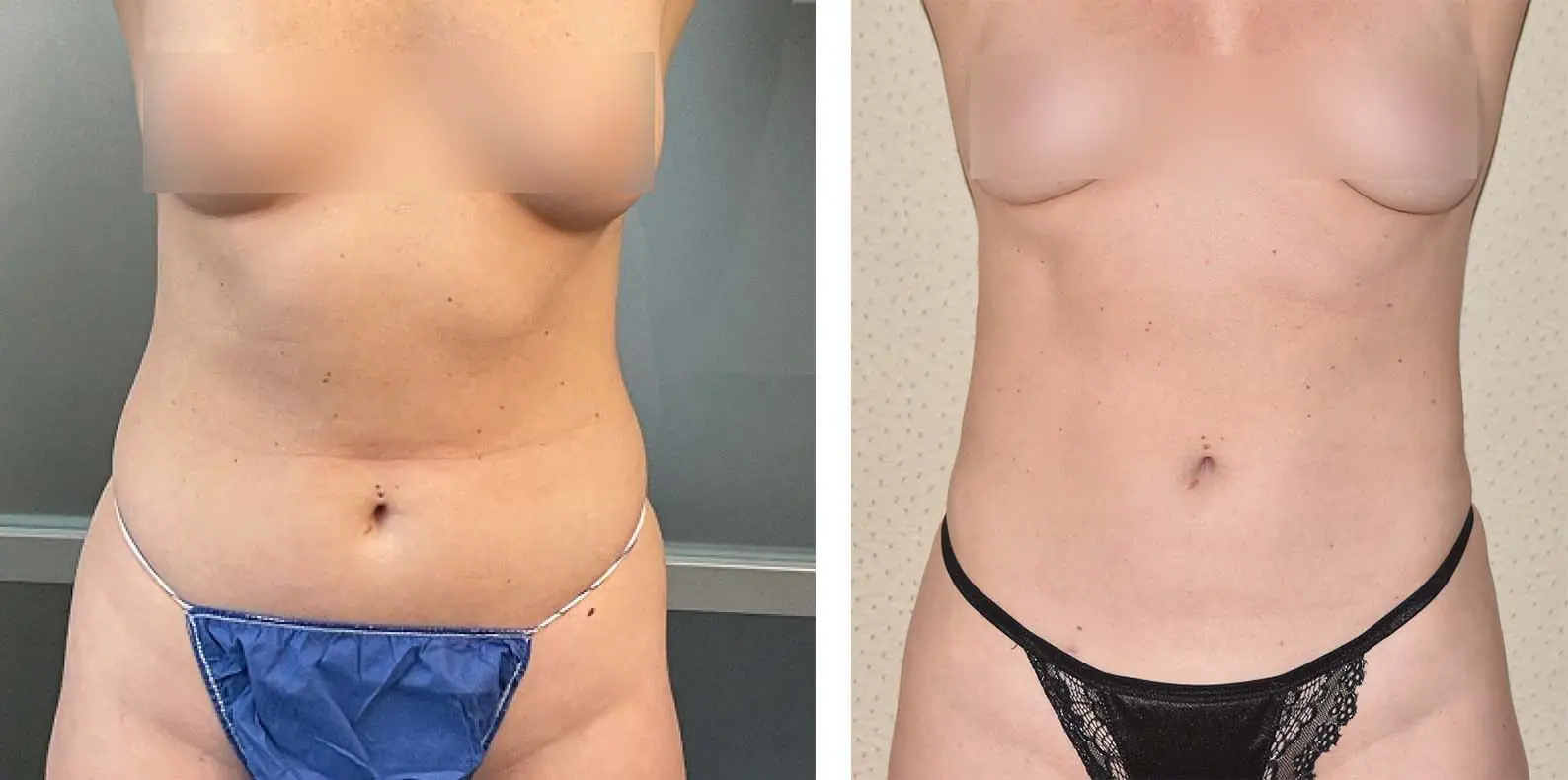 Before and after liposuction, case 19.