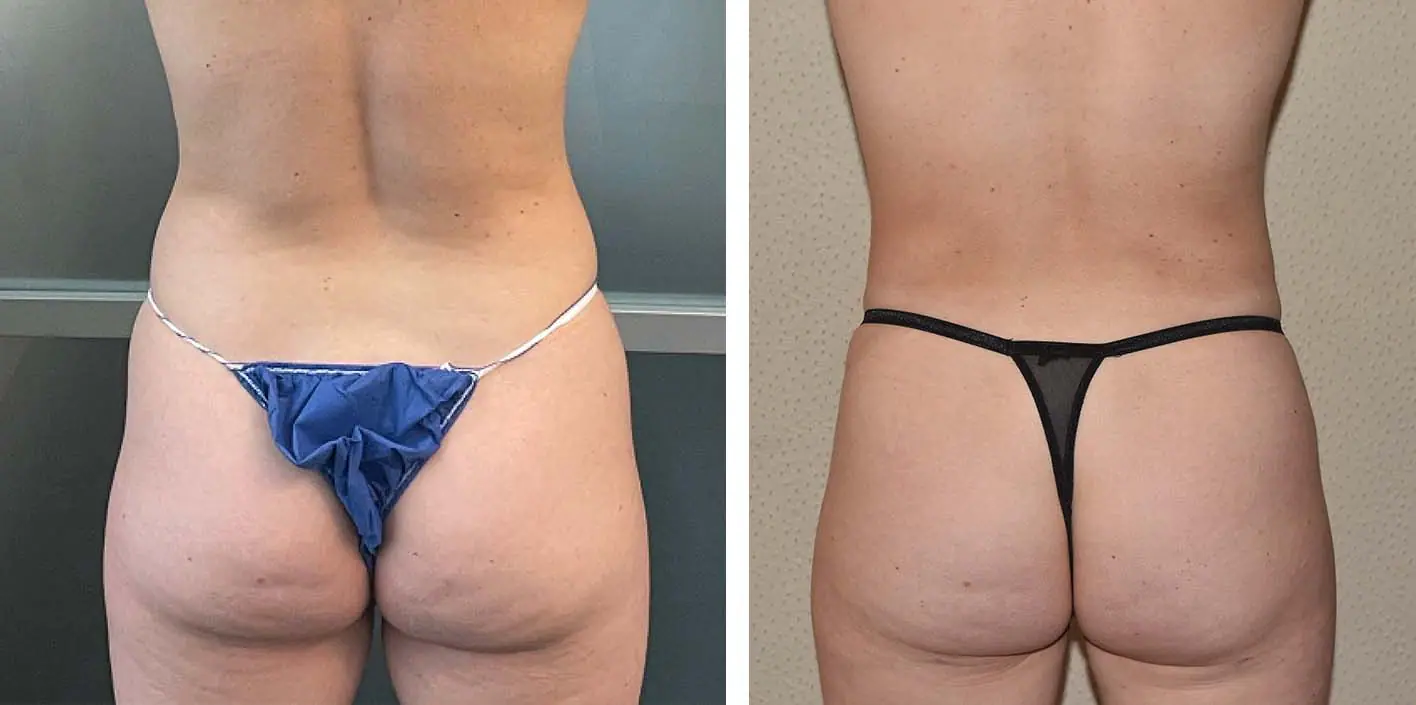Before and after liposuction, case 21.