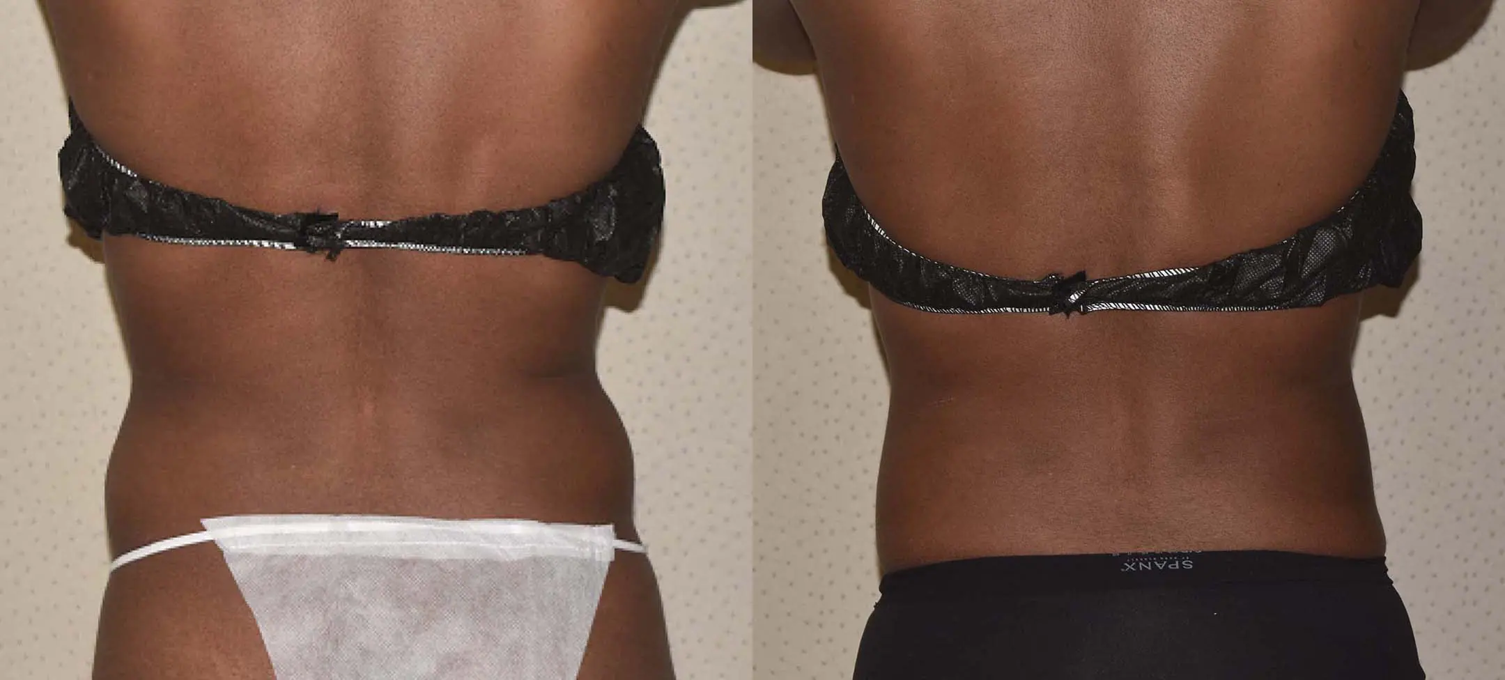 Before and after liposuction, case 24.