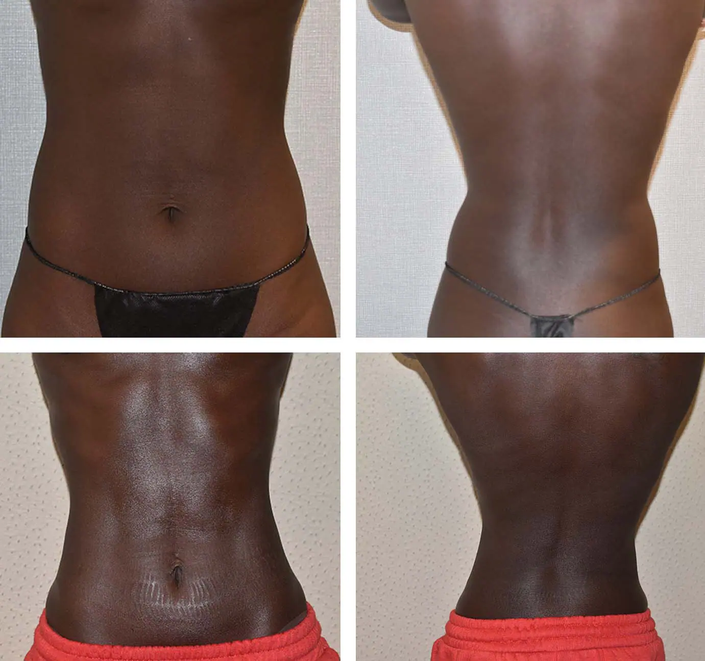 Before and after liposuction, case 27.
