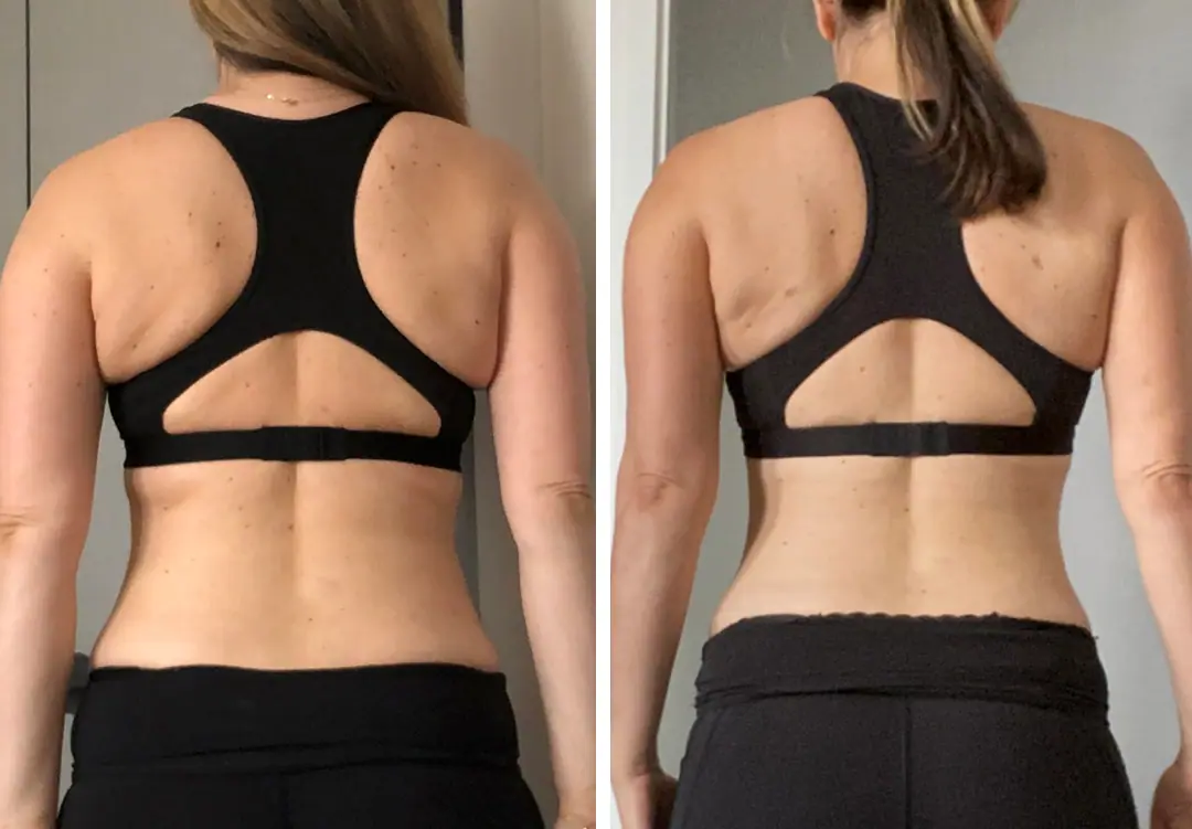 Before and after liposuction, case 28.