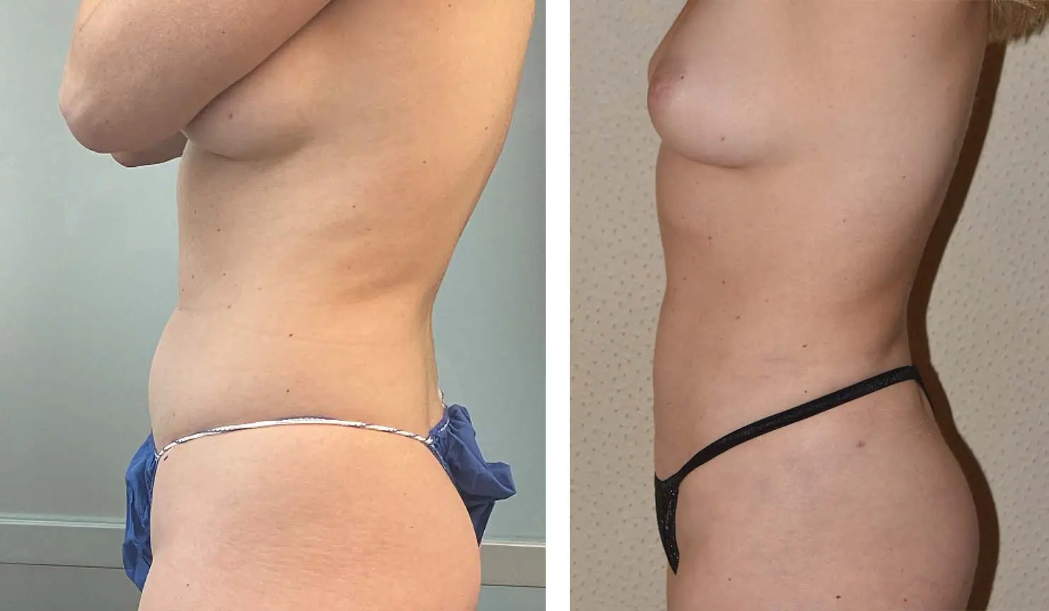 Before and after liposuction, case 29.